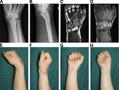 Rapid Spontaneous Total Fusion of Neuropathic Arthropathy of the Wrist After Limited Intercarpal Arthrodesis: A Case Report and Brief Literature Review